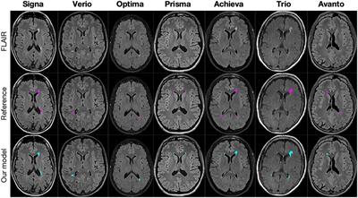 Scanner agnostic large-scale evaluation of MS lesion delineation tool for clinical MRI